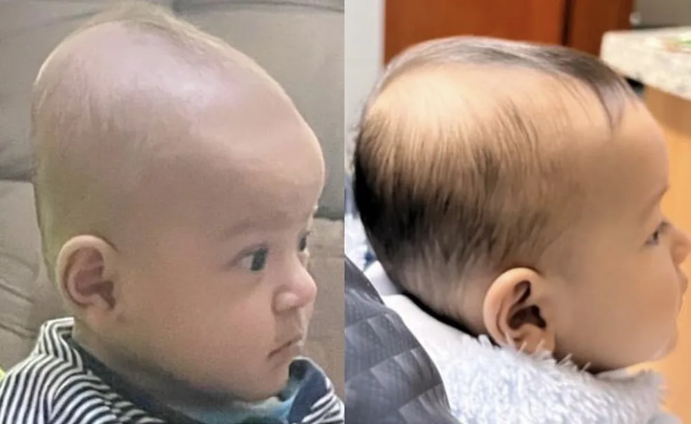 Comparação lado a lado do perfil do crânio de um bebê, antes e depois do acompanhamento fisioterapêutico