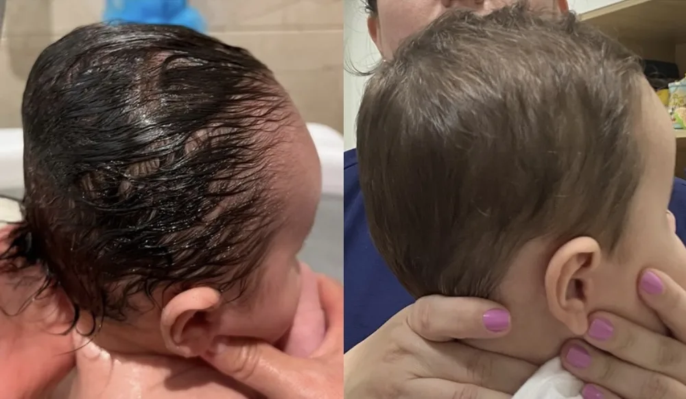 Comparação lado a lado da vista posterior do crânio de um bebê, antes e depois do acompanhamento