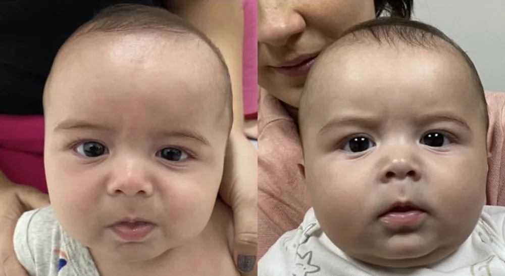 Comparação frontal do rosto de um bebê, antes e depois do acompanhamento fisioterapêutico
