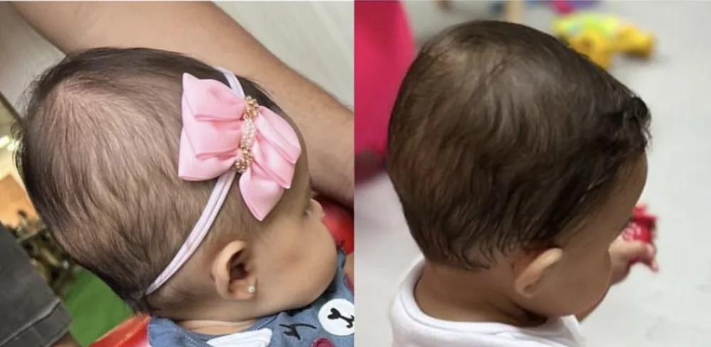 Comparação lateral do crânio de um bebê, antes e depois do acompanhamento fisioterapêutico